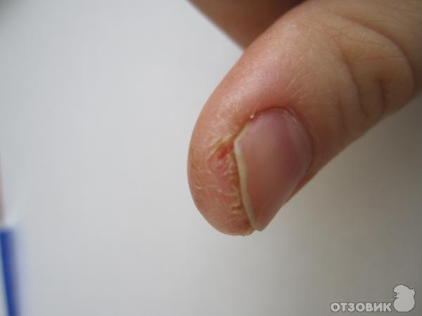 Почему на руках возле ногтей трескается кожа?